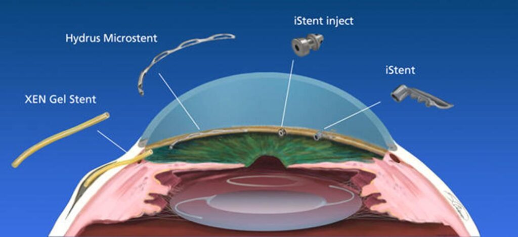 Minimally Invasive Glaucoma Surgery (MIGS)