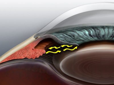 Open-Angle Glaucoma Treatment