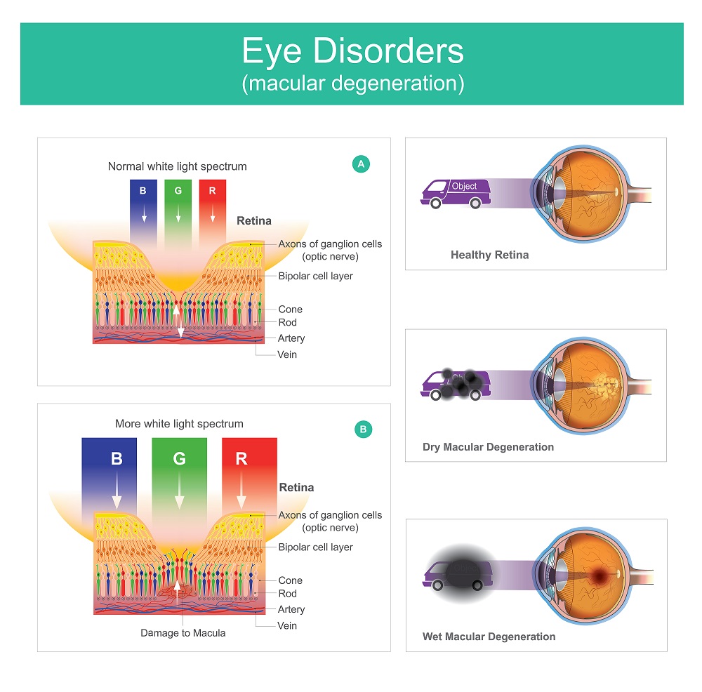 Optics and Eye Care