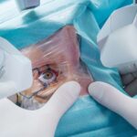 Cataract Surgery: What to Expect and How to Prepare