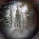 SMILE Laser Eye Surgery for Dry Eyes: Does It Really Help?